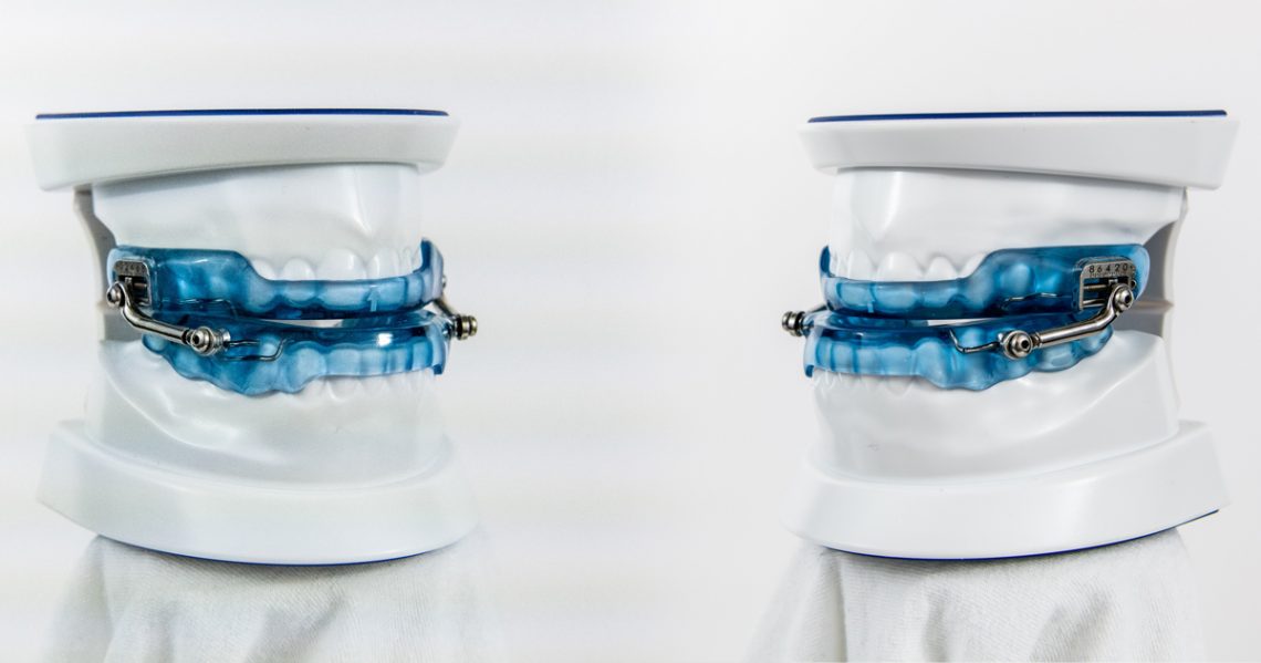 ApneaGuard Oral Appliance Therapy